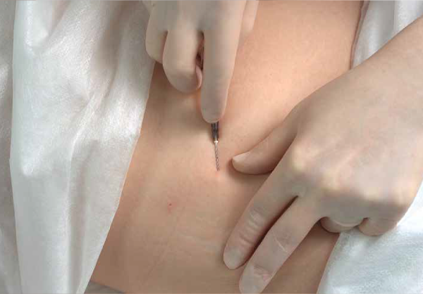 Постпроцедурно