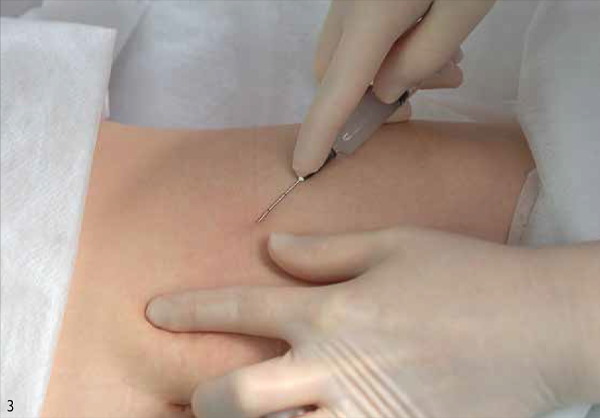 Обработка зоны коррекции