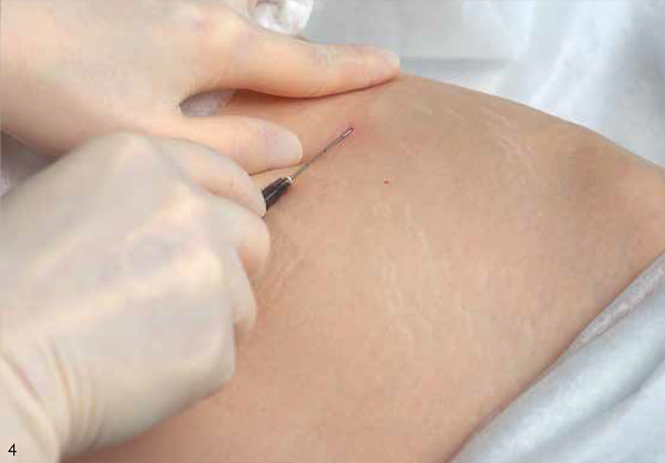 Введение препарата