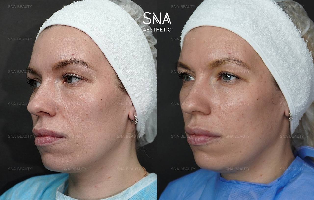 До / После L(+) Lift®