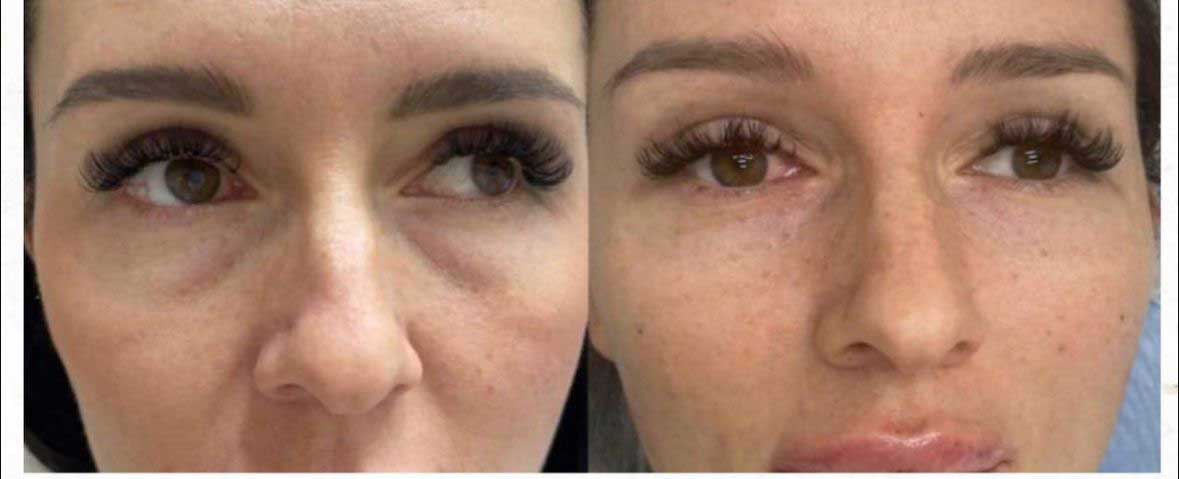 До / После L(+) Lift®