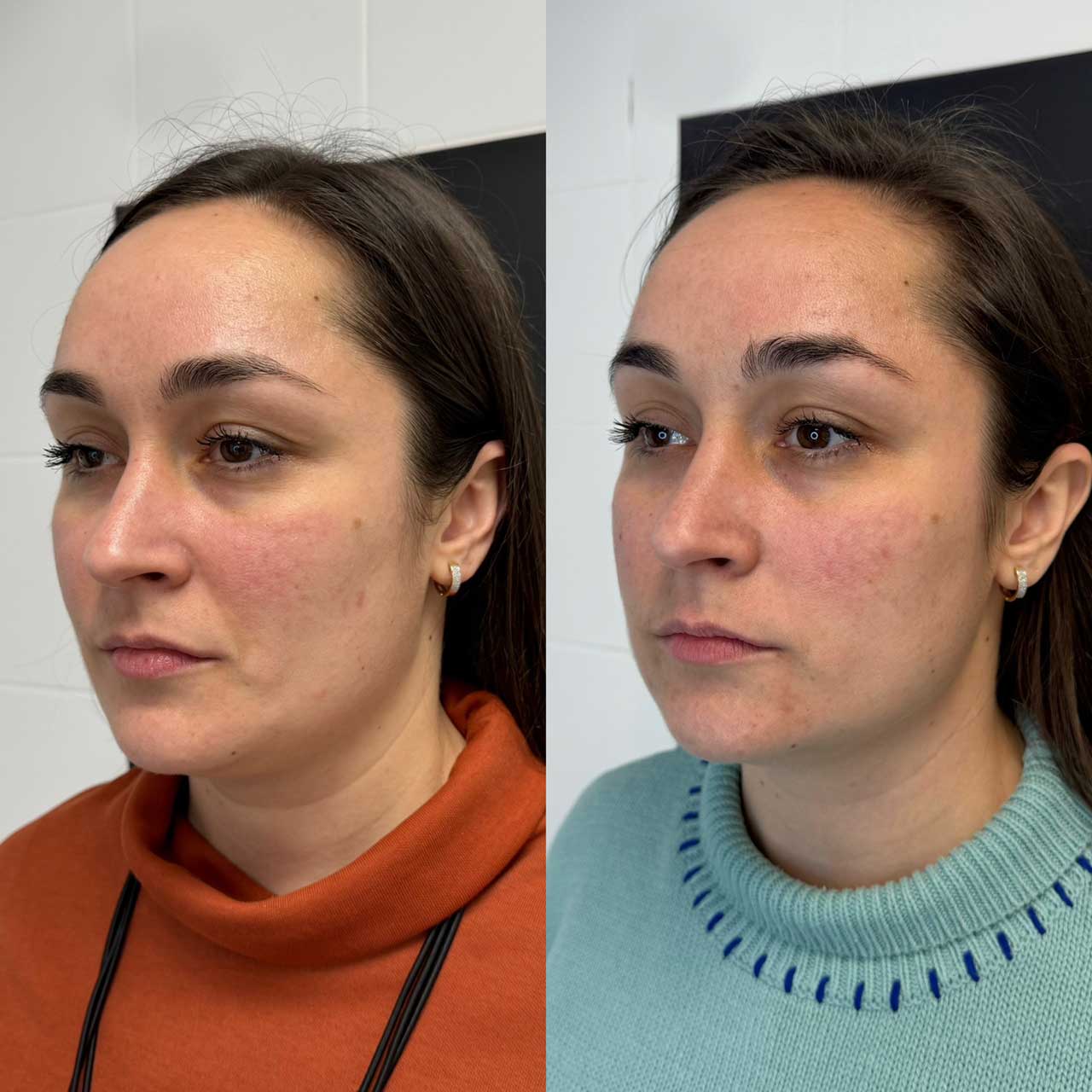 До / После L(+) Lift®