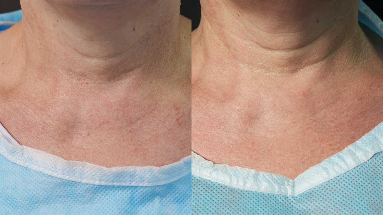 До / После L(+) Lift®