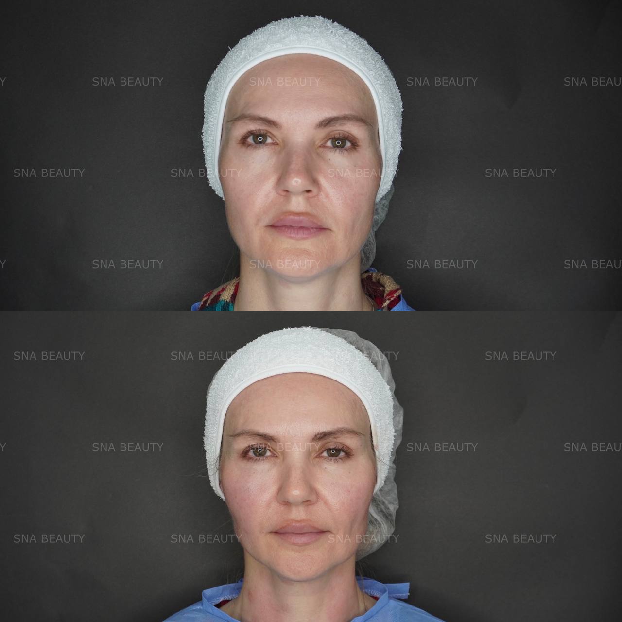 До / После L(+) Lift®