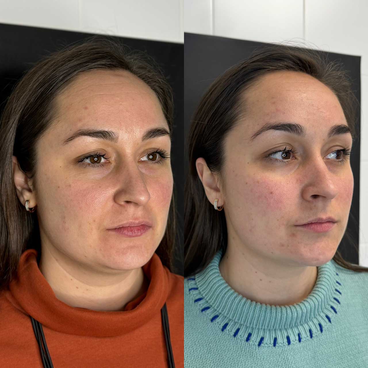 До / После L(+) Lift®