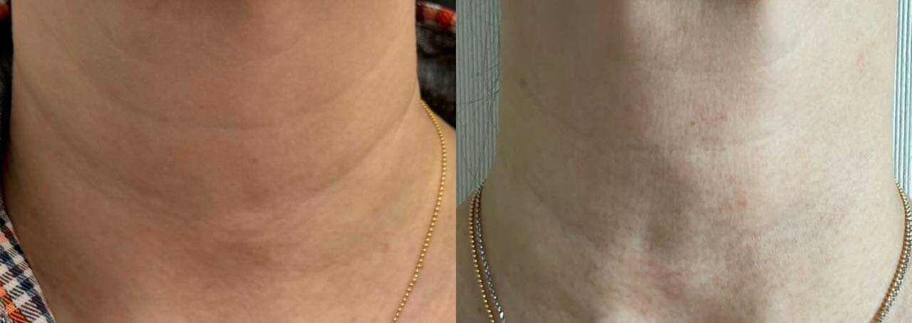 До / После L(+) Lift®