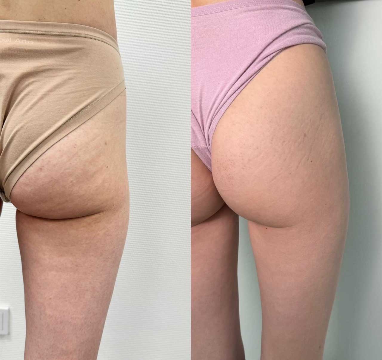 До / После L(+) Lift®