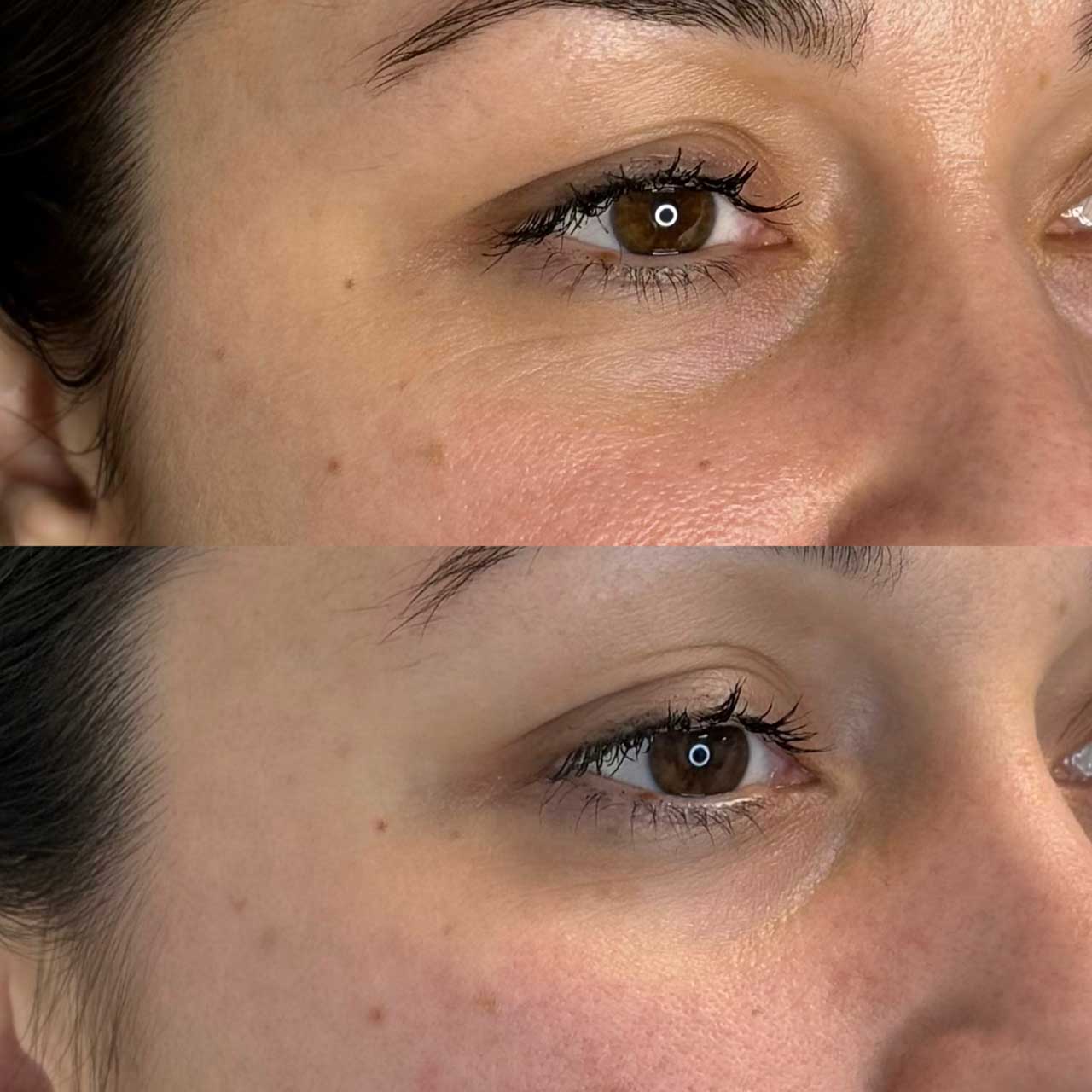 До / После L(+) Lift®