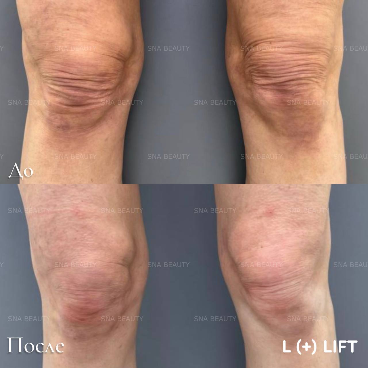 До / После L(+) Lift®