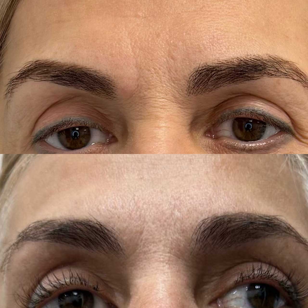 До / После L(+) Lift®