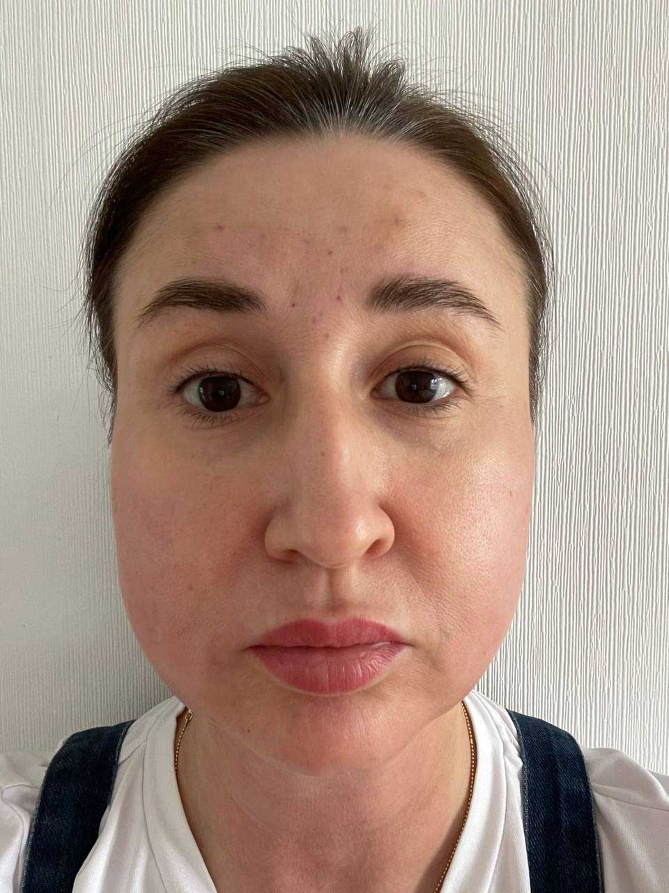 До / После L(+) Lift®