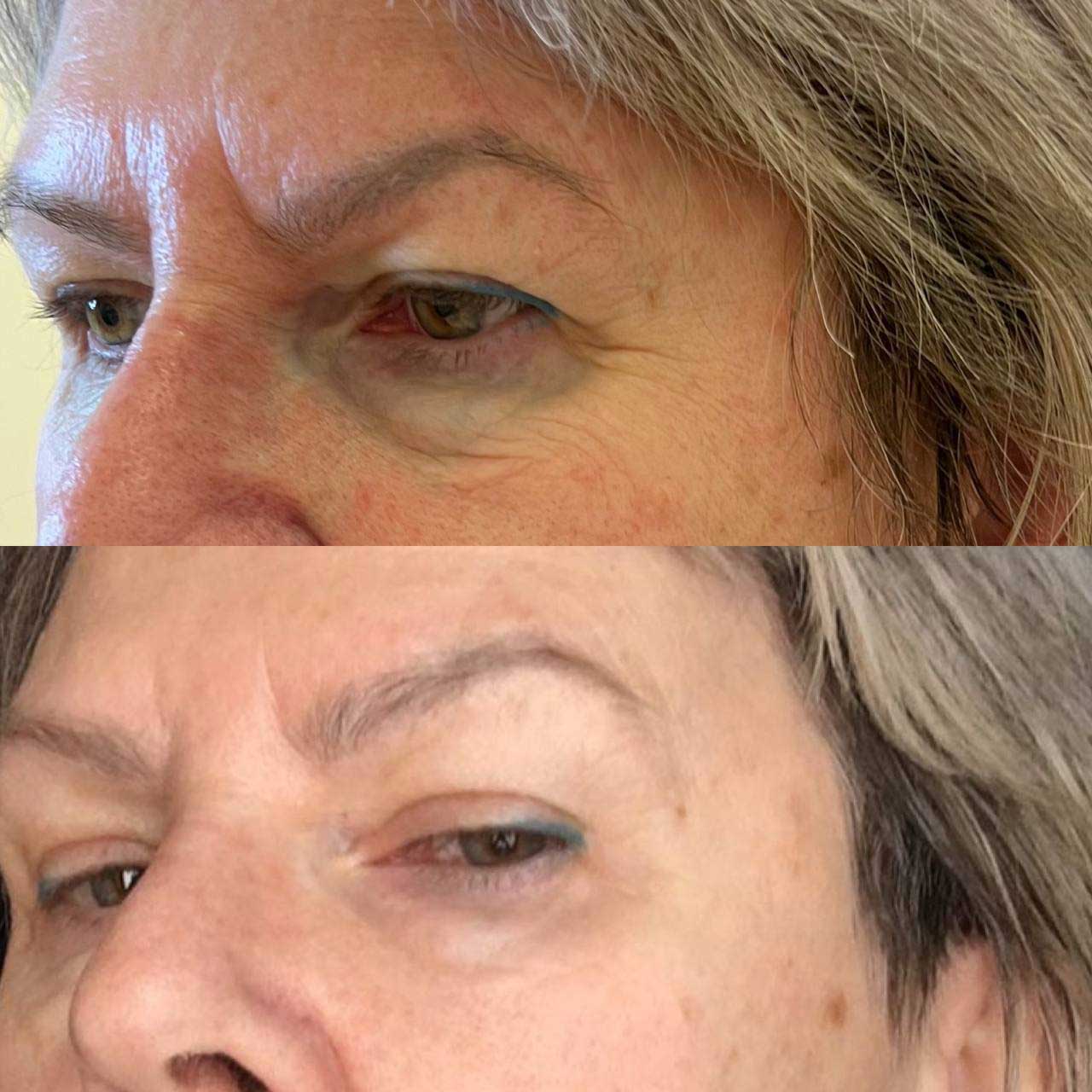 До / После L(+) Lift®