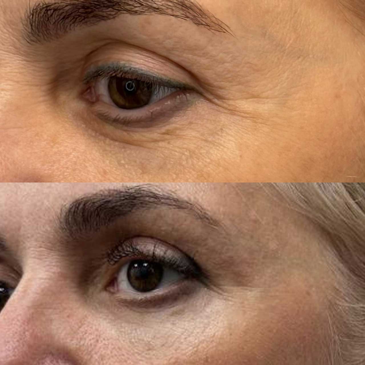 До / После L(+) Lift®