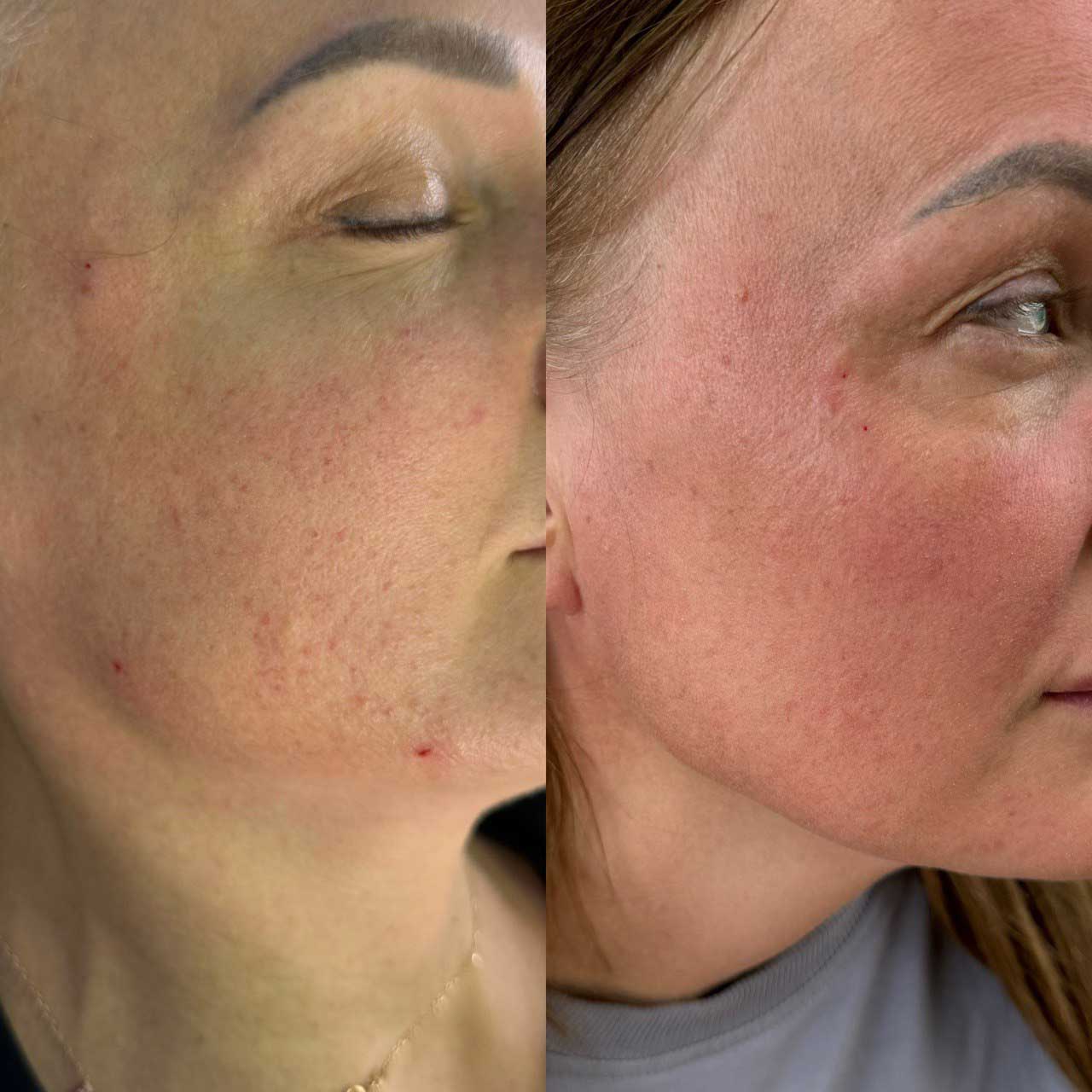 До / После L(+) Lift®