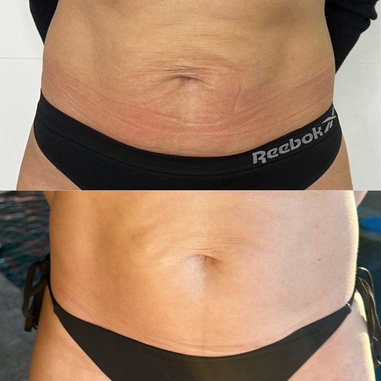 До / После L(+) Lift®