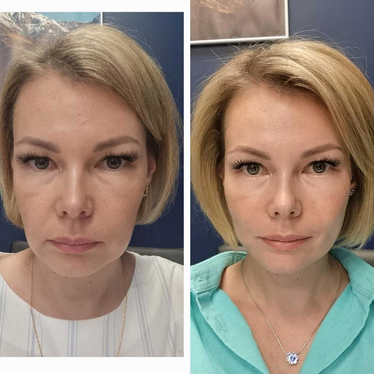 До / После L(+) Lift®