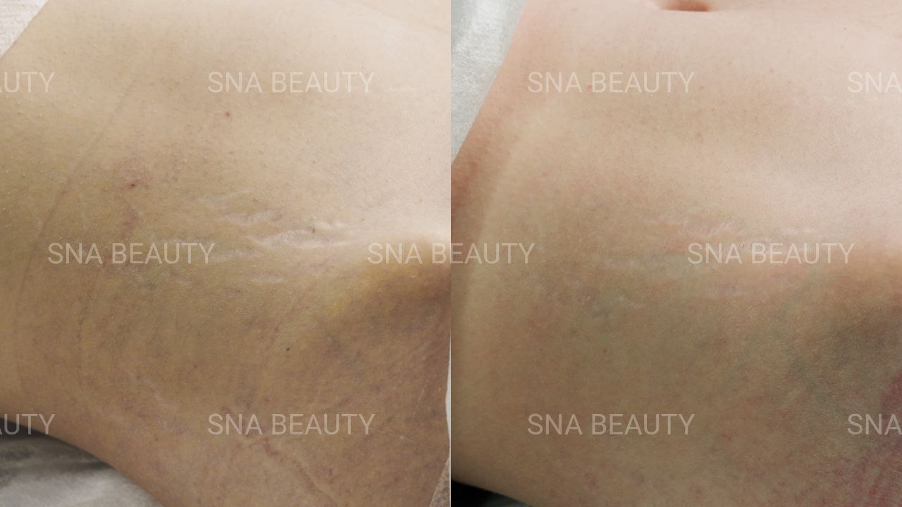 До / После L(+) Lift®