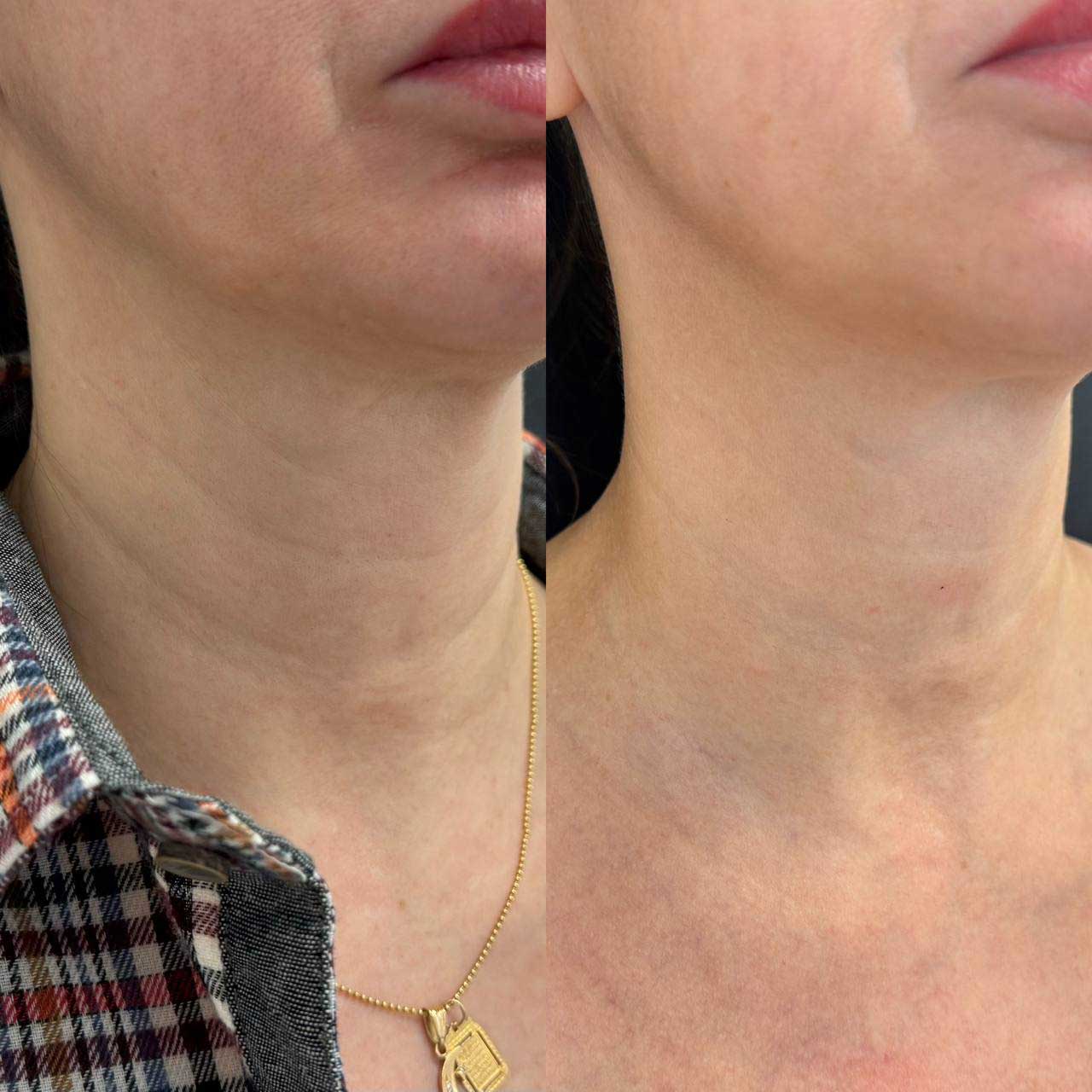 До / После L(+) Lift®