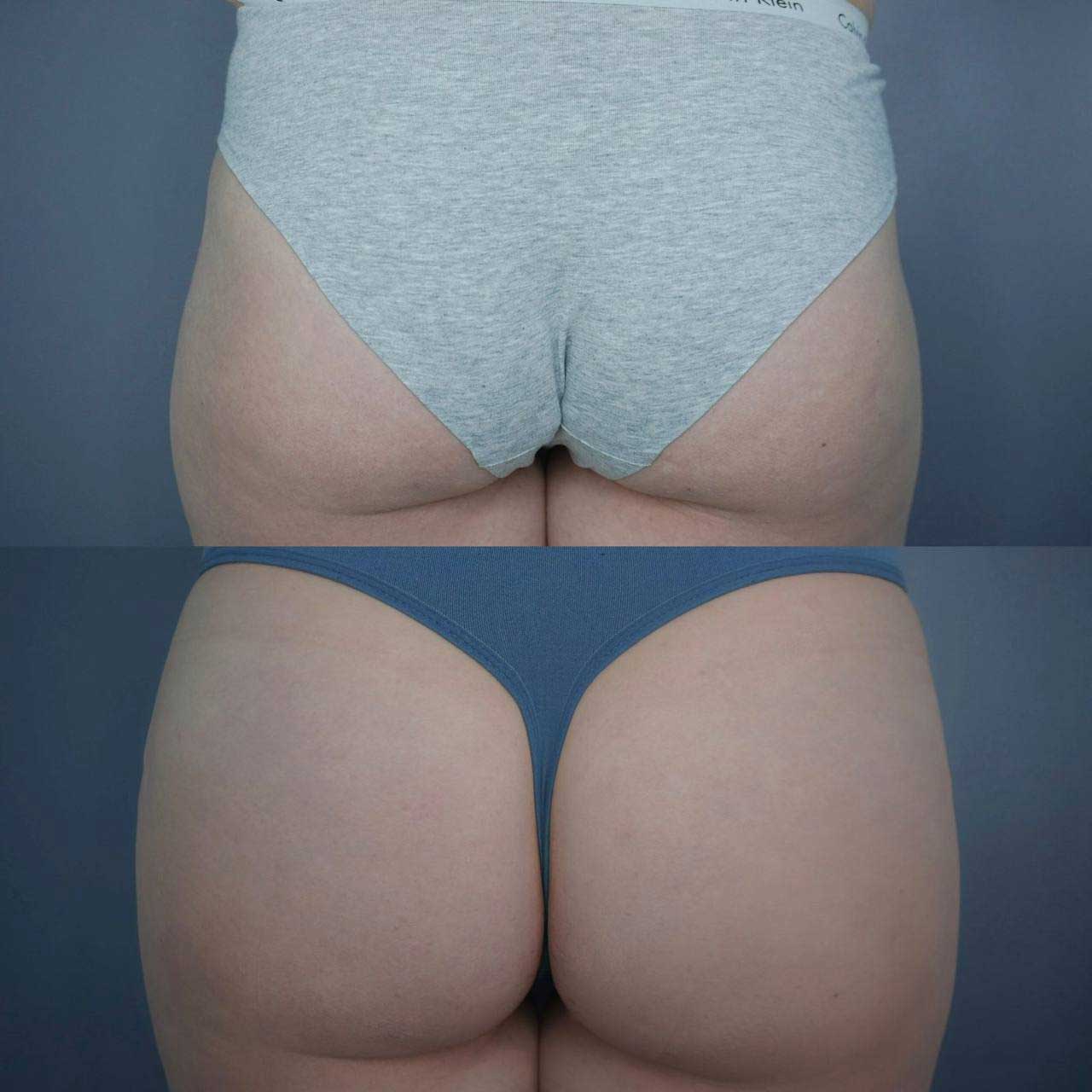 До / После L(+) Lift®