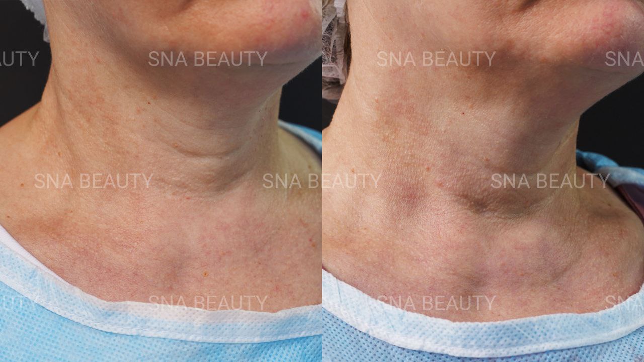 До / После L(+) Lift®