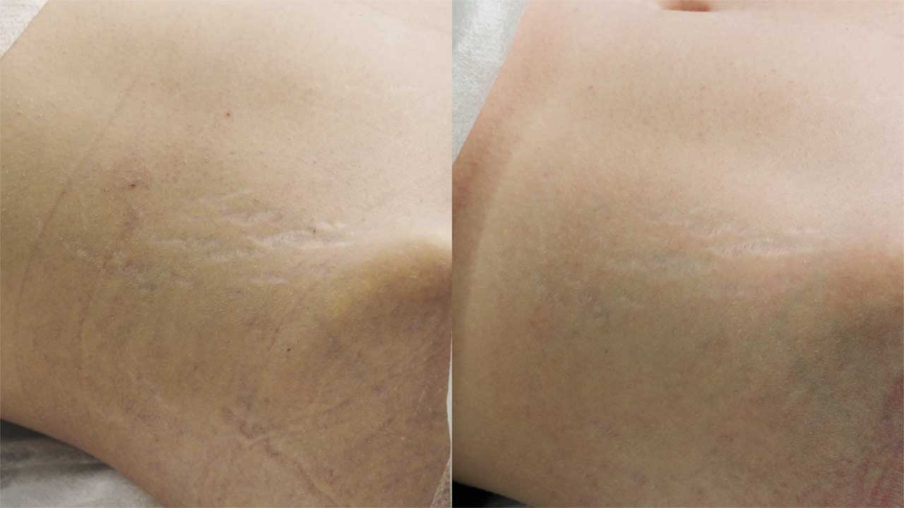 До / После L(+) Lift®