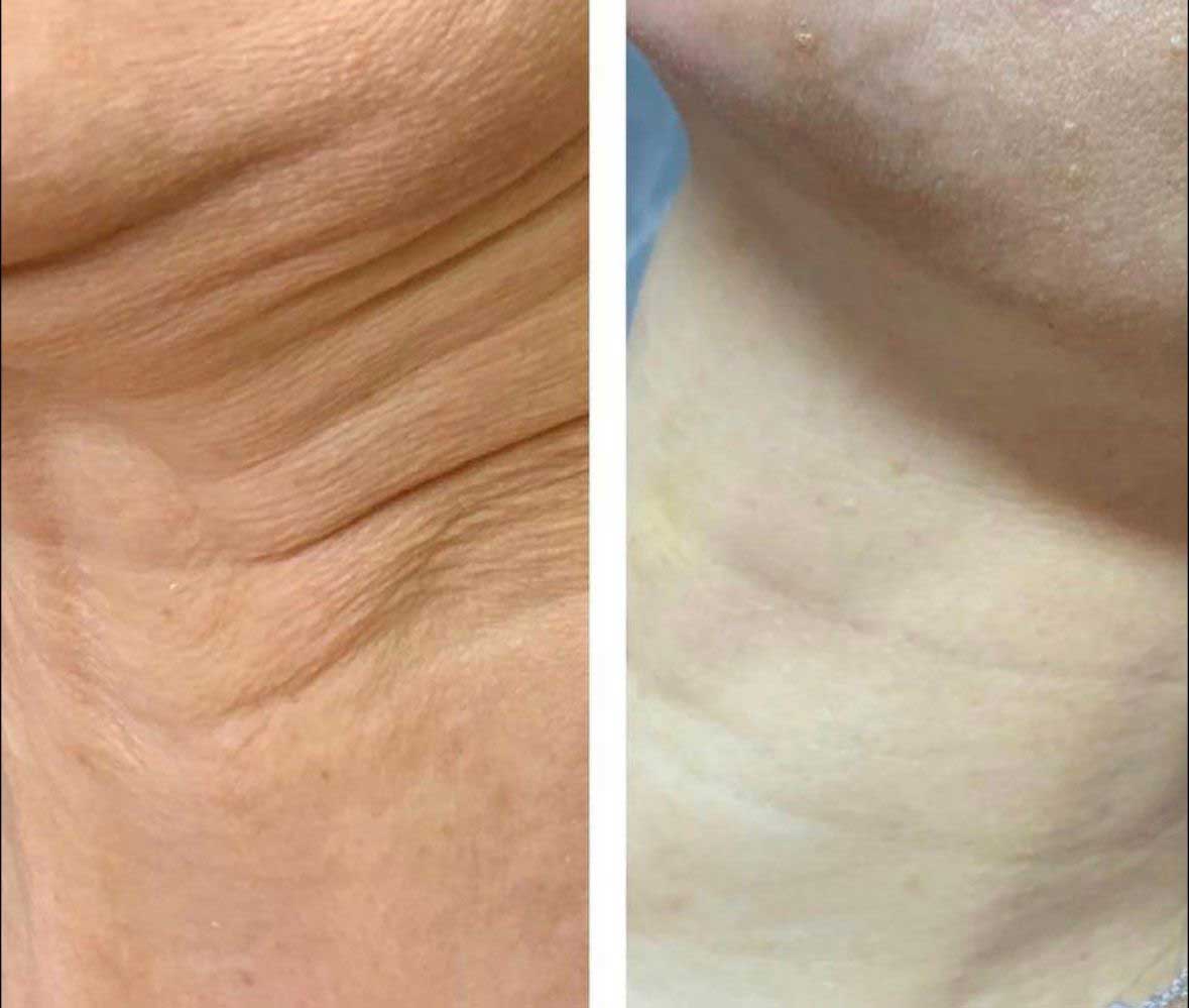 До / После L(+) Lift®