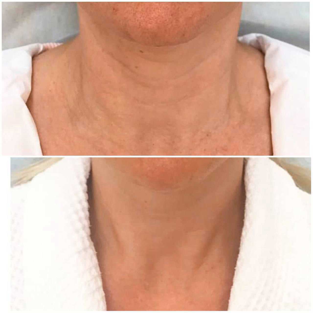 До / После L(+) Lift®