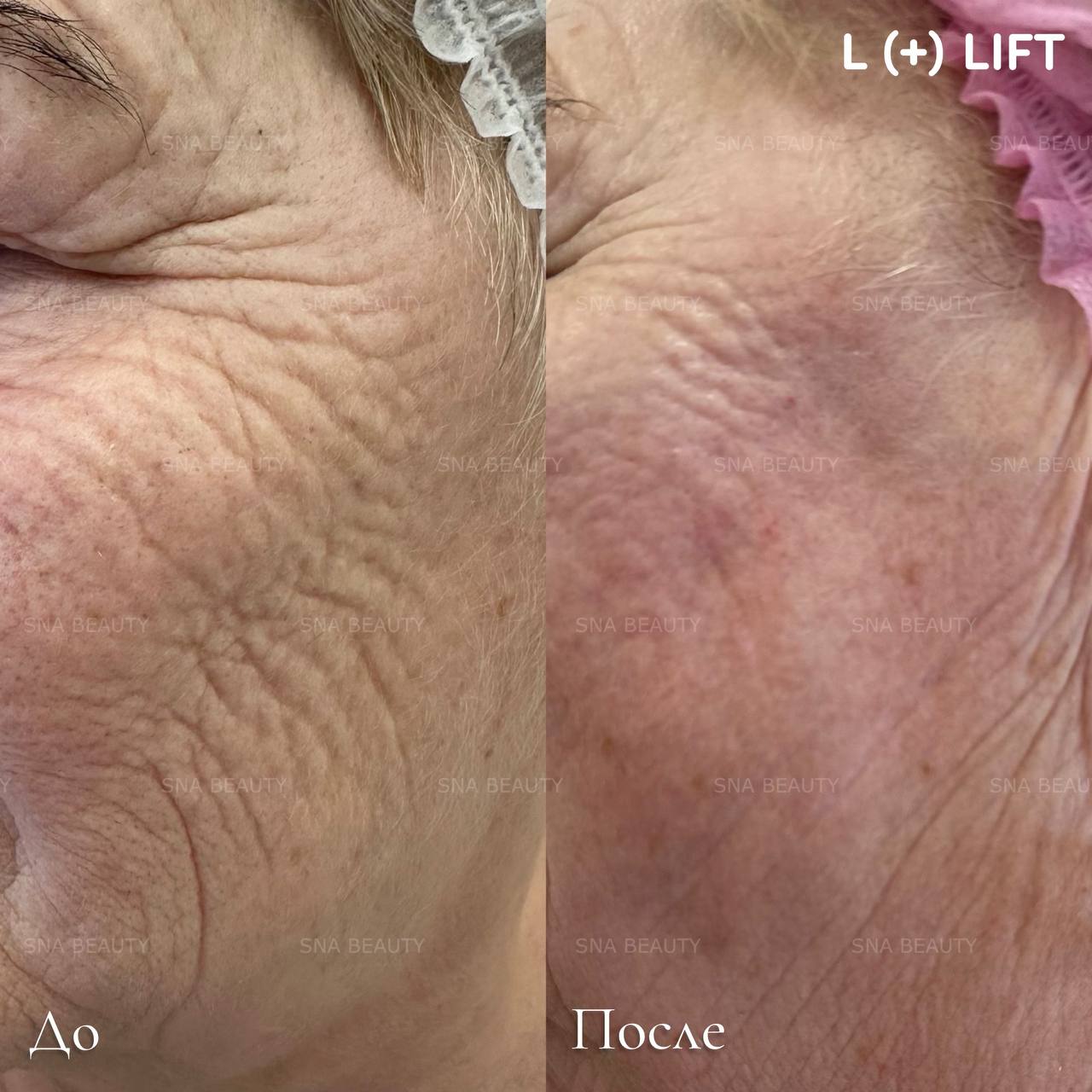 До / После L(+) Lift®