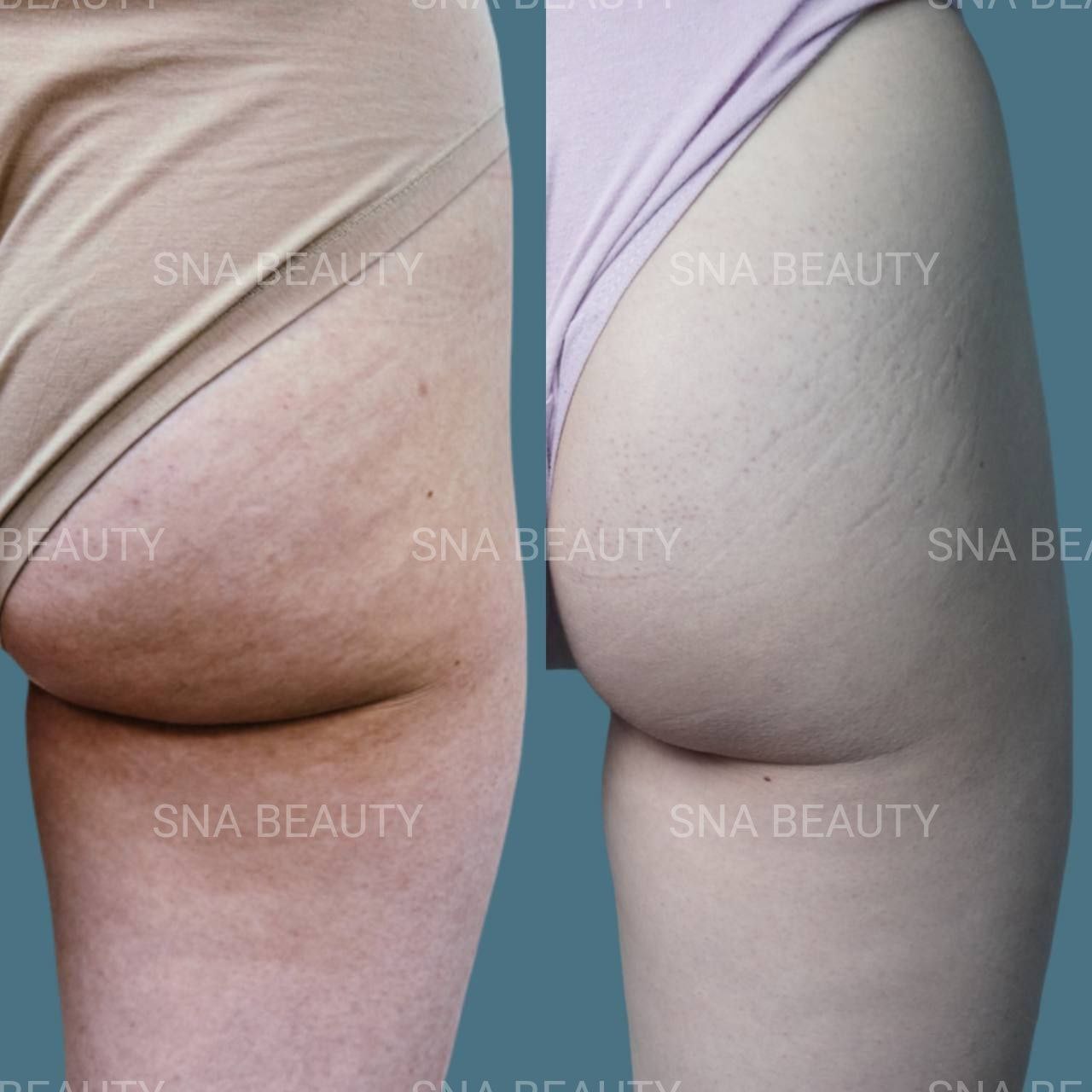 До / После L(+) Lift®