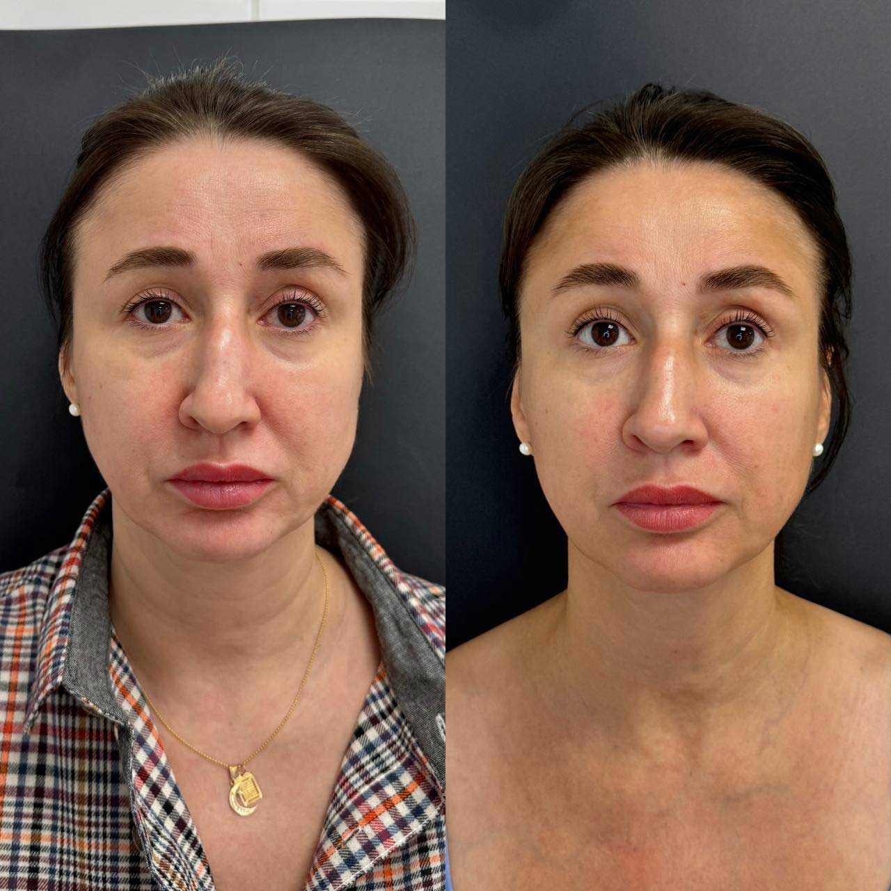 До / После L(+) Lift®