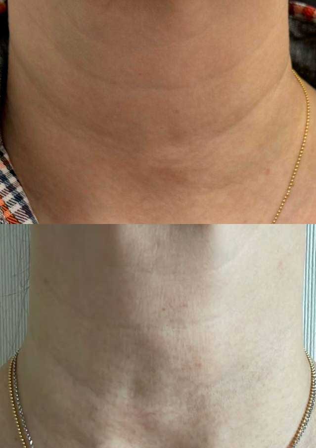 До / После L(+) Lift®