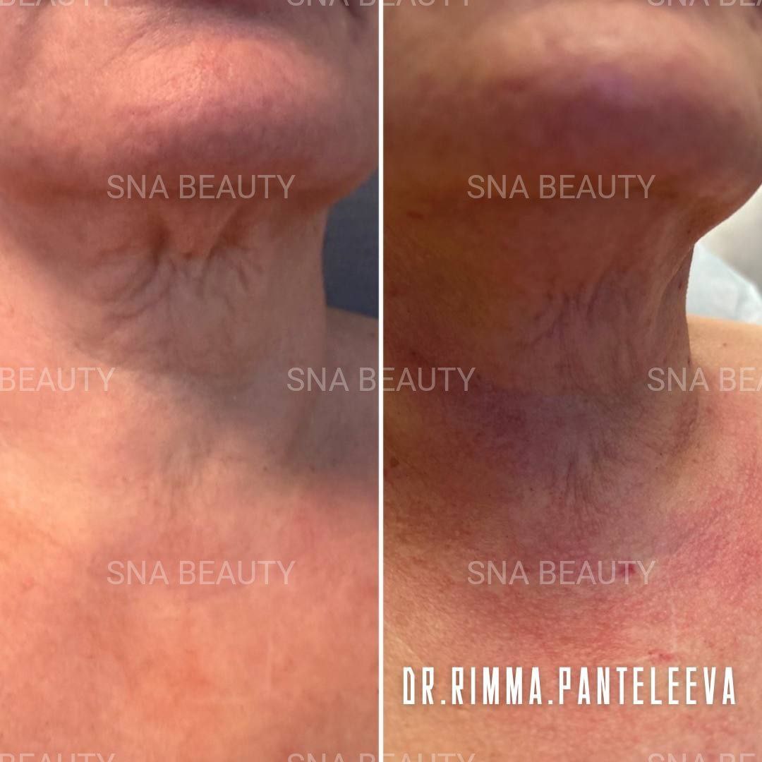 До / После L(+) Lift®