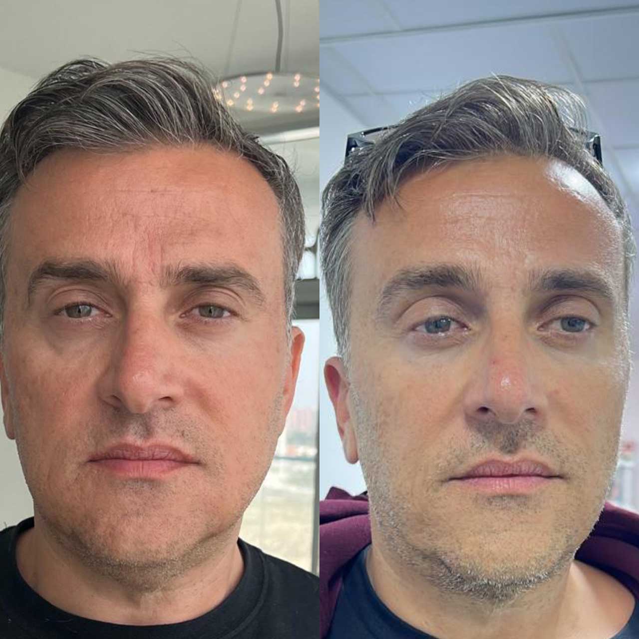 До / После L(+) Lift®