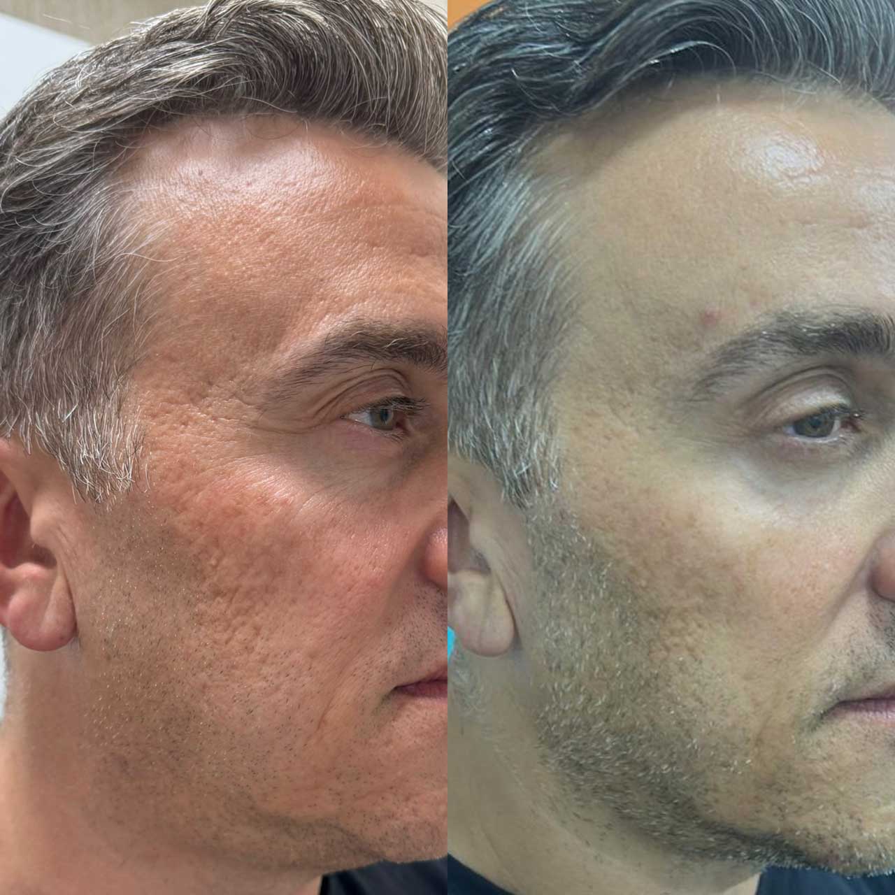 До / После L(+) Lift®