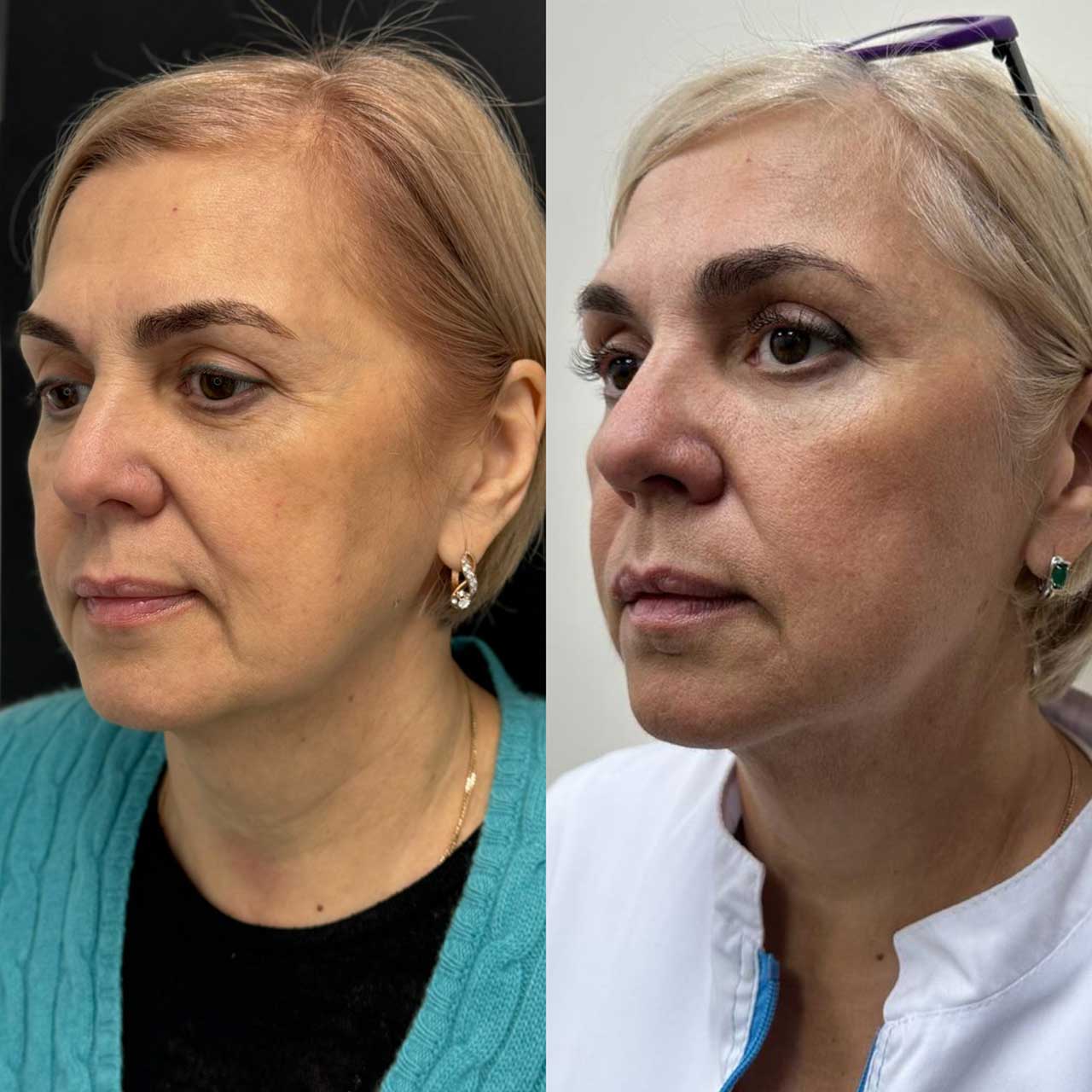 До / После L(+) Lift®