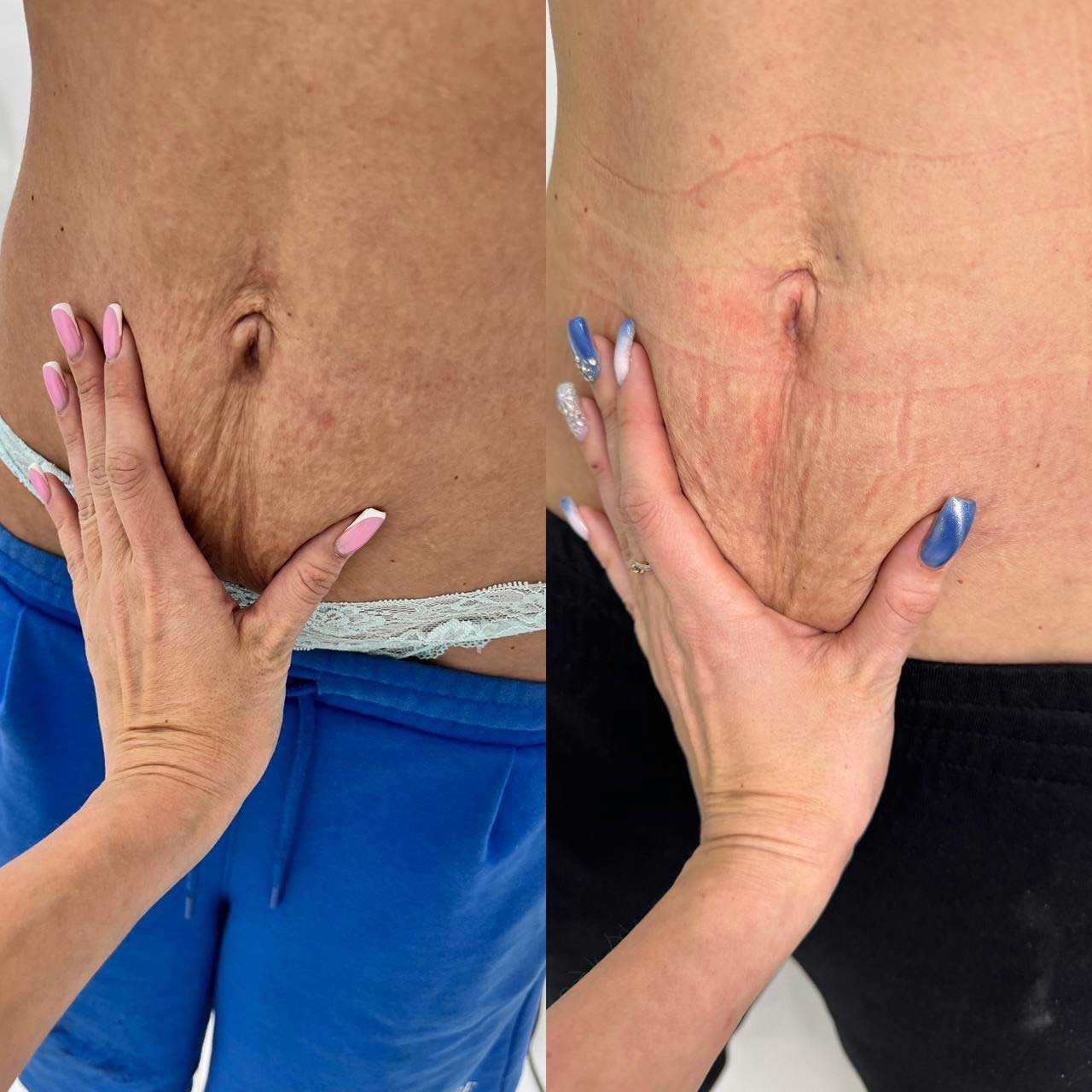 До / После L(+) Lift®