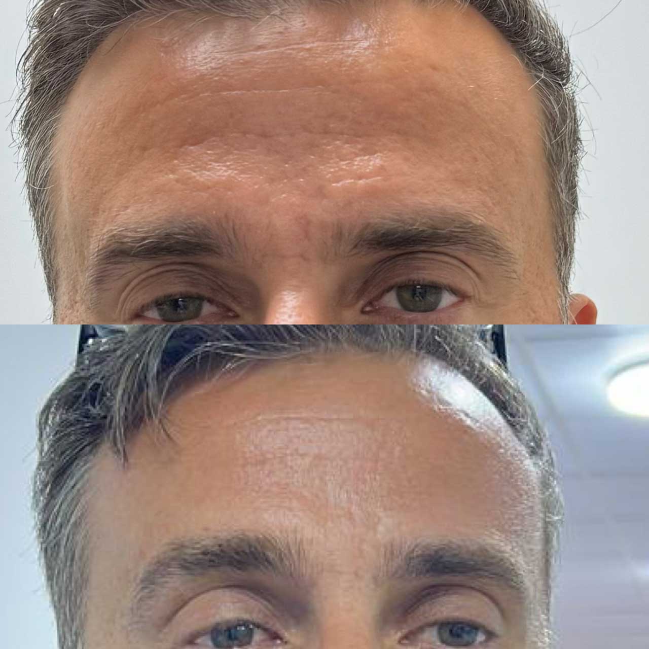 До / После L(+) Lift®