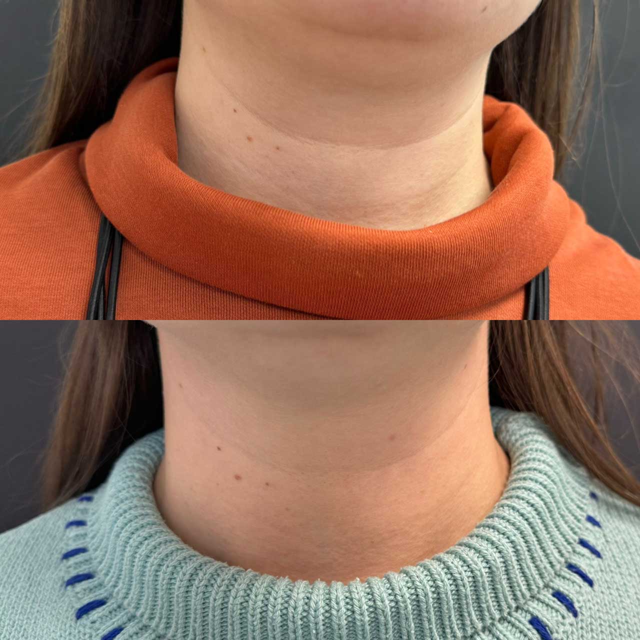 До / После L(+) Lift®