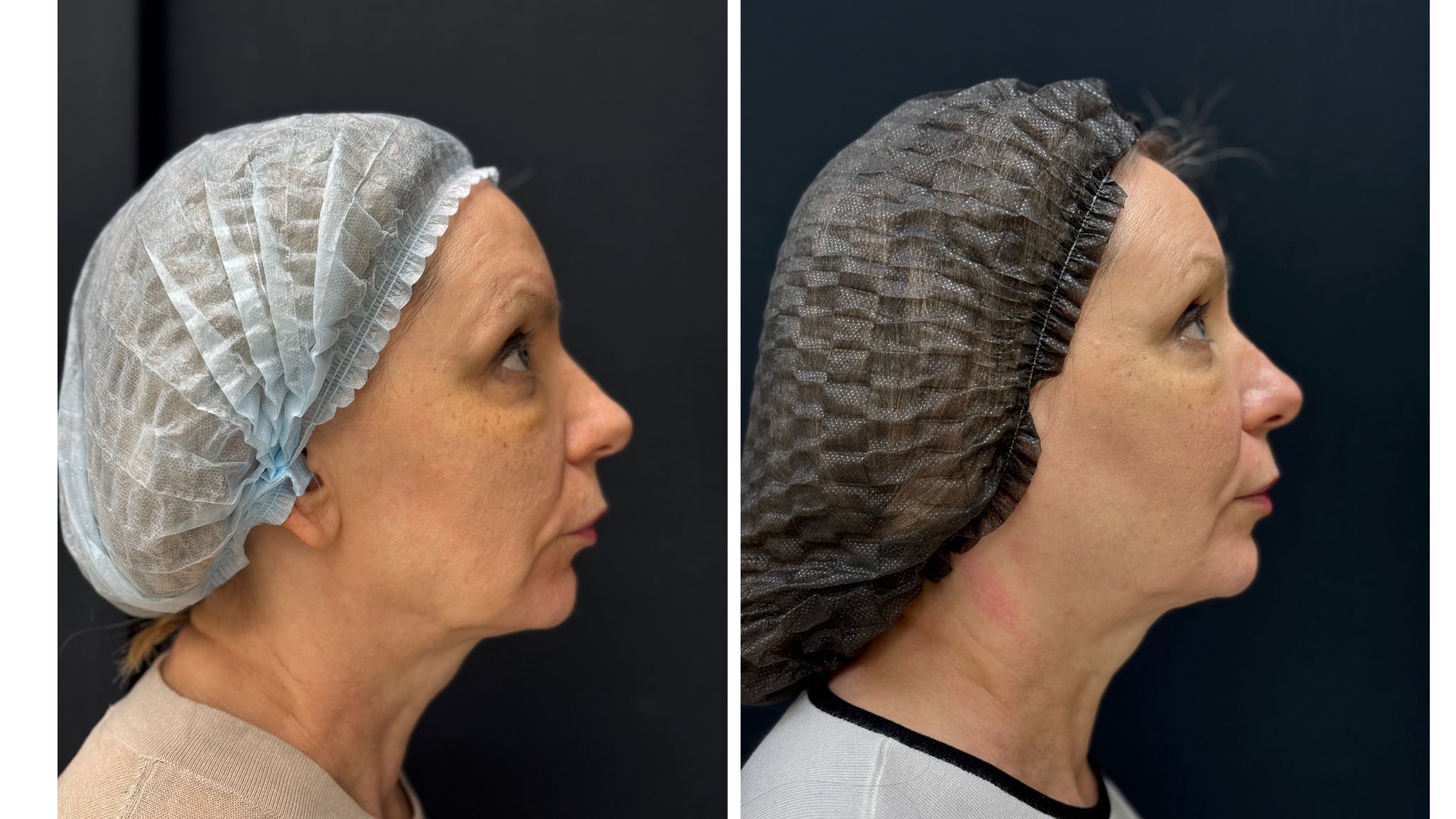 До / После L(+) Lift®