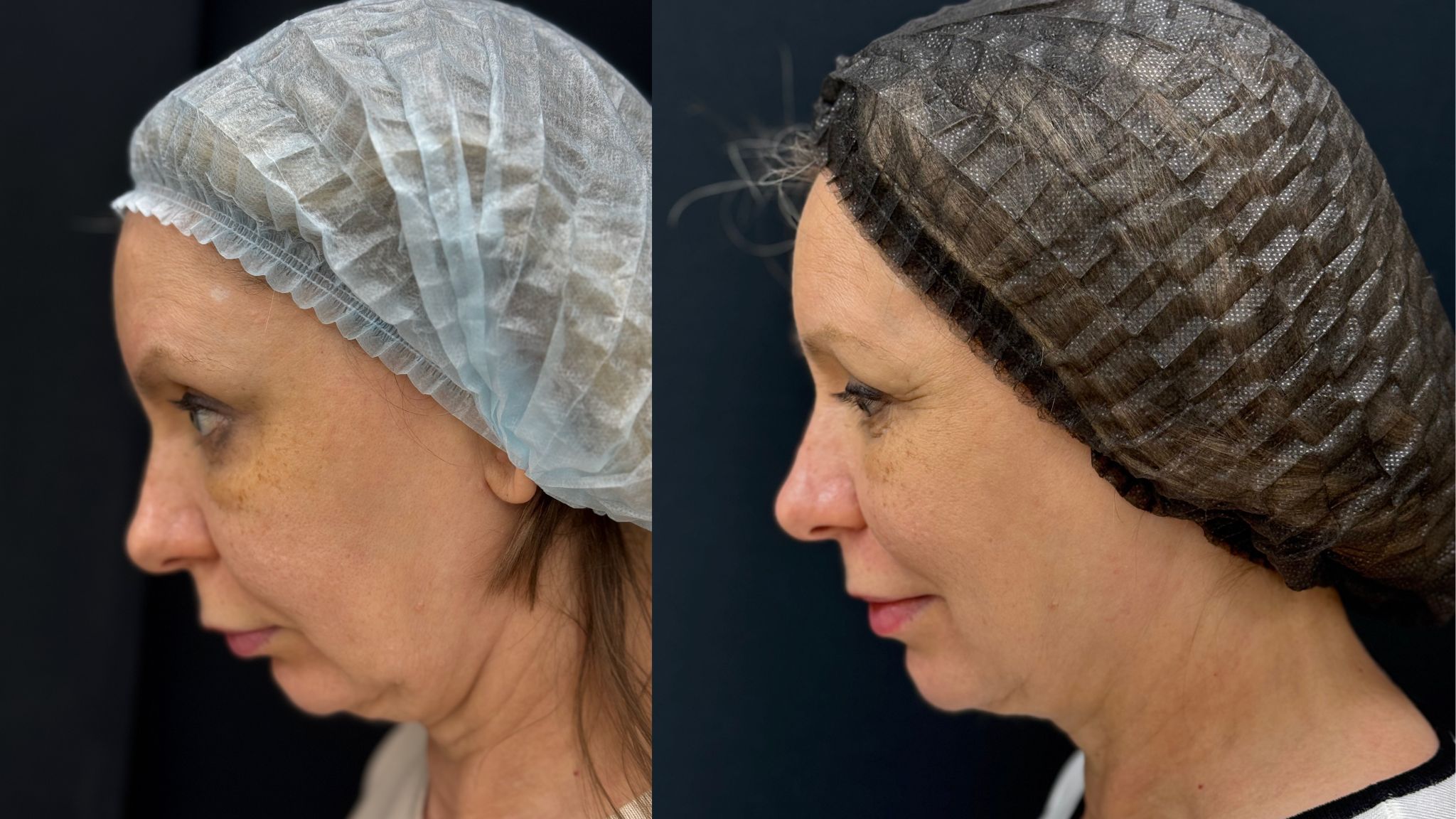 До / После L(+) Lift®