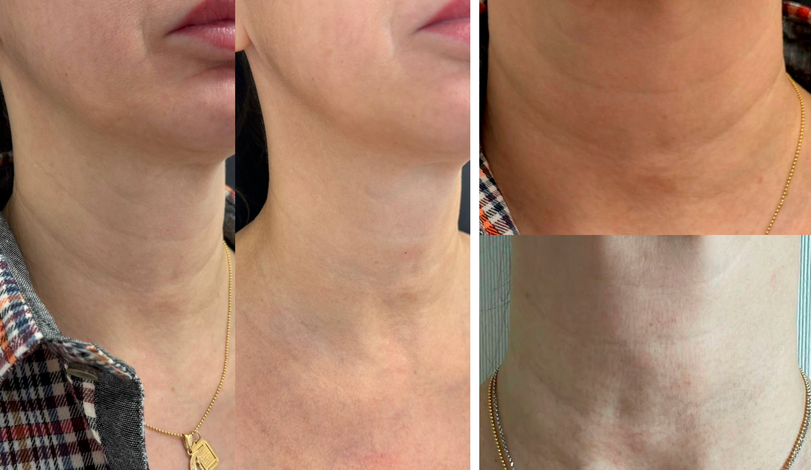 До / После L(+) Lift®