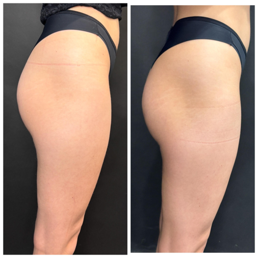 До / После L(+) Lift®