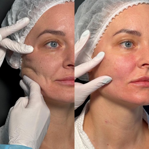 До / После L(+) Lift®